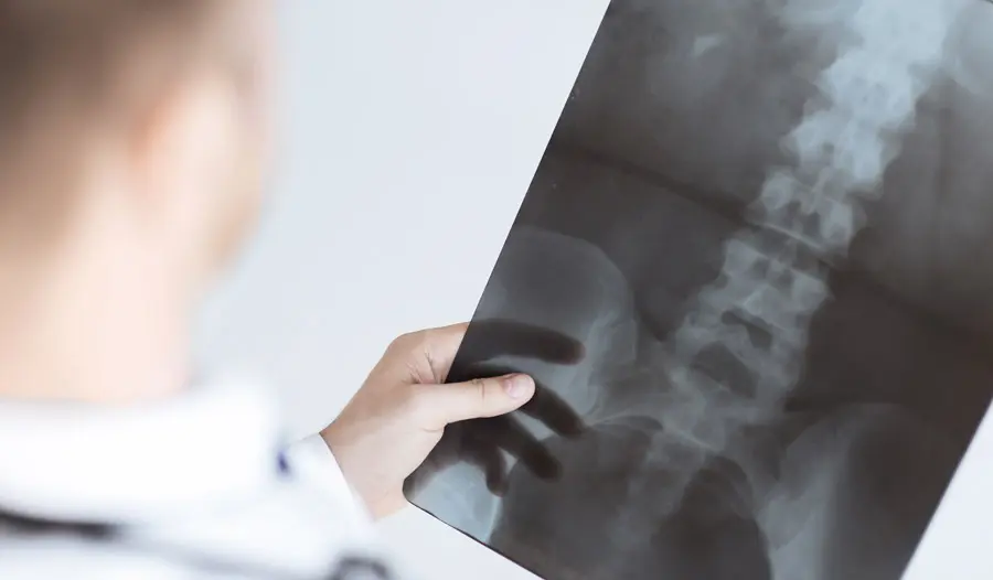 NJ Failed Back Surgery Syndrome - Bergen/Passaic County