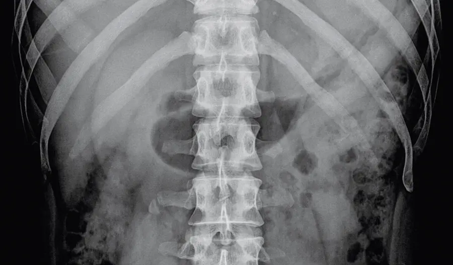 NJ Herniated Disc Treatment - Bergen/Passaic County